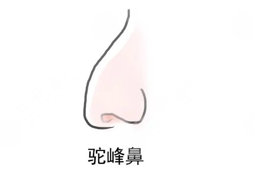 駝峰鼻矯正手術(shù)多少錢？