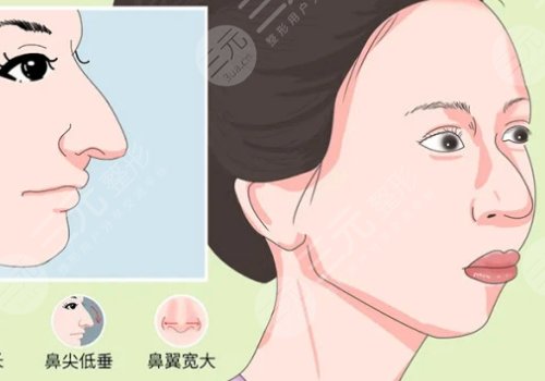 駝峰鼻矯正手術(shù)多少錢？