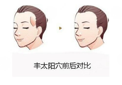 填充太陽凹陷脂肪能保持多久?