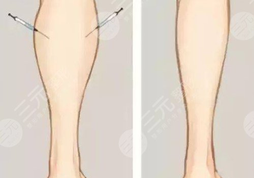 小腿吸脂后多久可以正常走路？