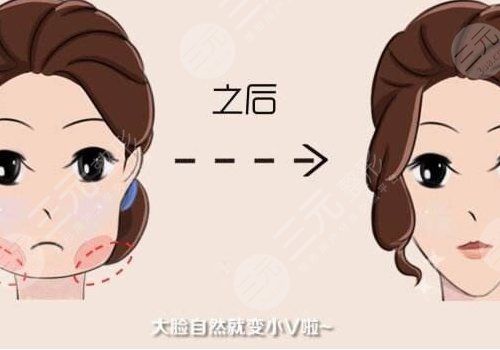 下頜緣輪廓注射多少錢？能維持多久？