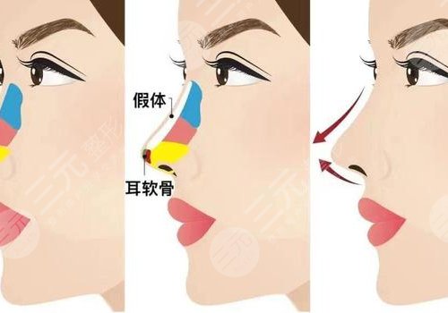 隆鼻假體取出來后能恢復(fù)到以前嗎？