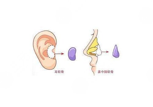 隆鼻假體取出來后能恢復(fù)到以前嗎？
