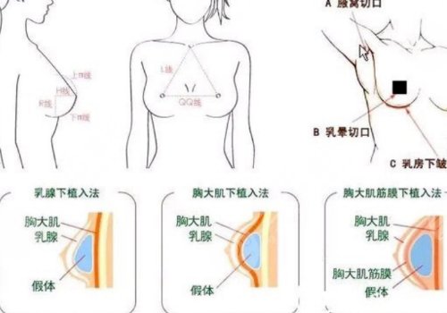豐胸手術(shù)對(duì)身體有什么影響？