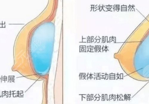 豐胸手術(shù)對(duì)身體有什么影響？
