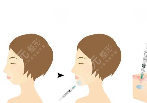 寶尼達(dá)玻尿酸適合注射在什么部位？