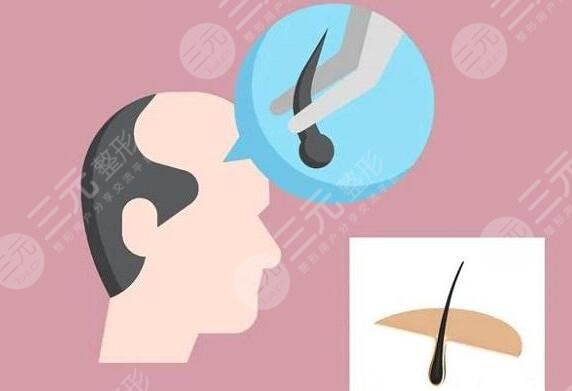 毛發(fā)種植的費(fèi)用是多少2023？?jī)r(jià)格影響根源所在，30秒速覽~