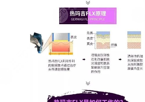 fotona4D和熱瑪吉的區(qū)別|哪個(gè)效果好？