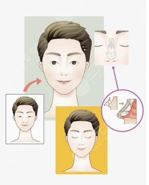 李愛林做鼻子怎么樣？醫(yī)生資料詳情、手術(shù)風(fēng)格夸張嗎？整友術(shù)后反饋來襲~