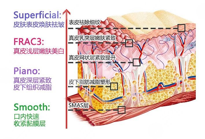 fotona4D和熱瑪吉的區(qū)別|哪個(gè)效果好？