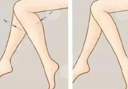 怎么快速瘦小腿？