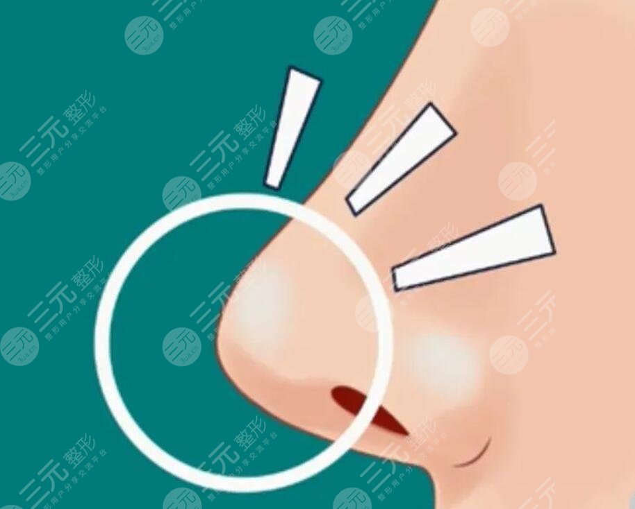 玻尿酸隆鼻有副作用嗎？該怎么避免玻尿酸隆鼻的副作用呢？