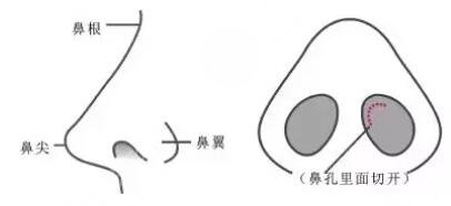 玻尿酸隆鼻有副作用嗎?