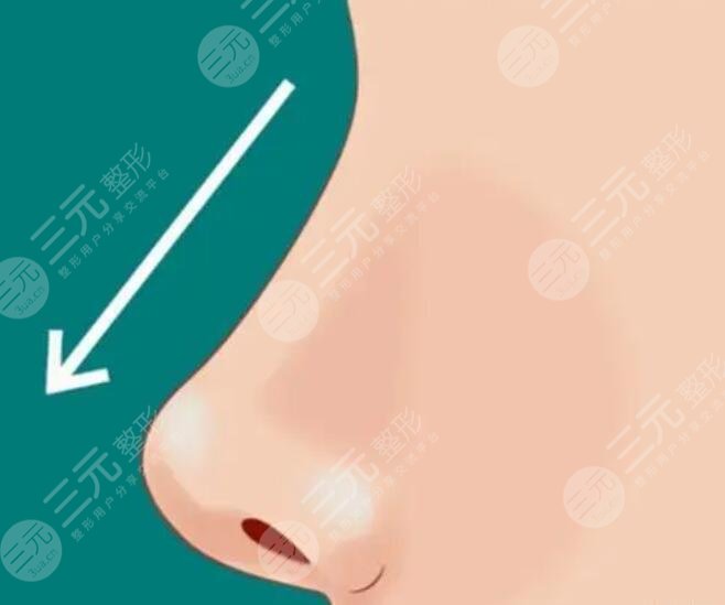 自體軟骨隆鼻材料好嗎？3大優(yōu)勢讓網(wǎng)紅明星趨之若鶩！