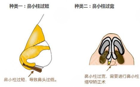 自體軟骨隆鼻的風(fēng)險