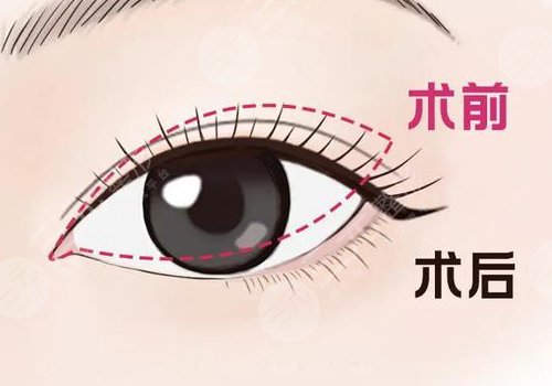 開眼角疼不疼呢？效果如何？