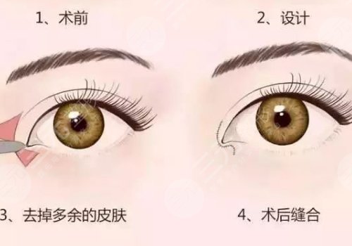 開眼角疼不疼呢？效果如何？