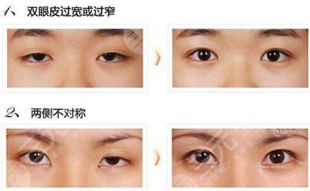 雙眼皮修復(fù)大概多少錢(qián)呢？
