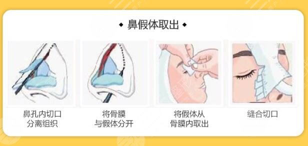 假體隆鼻后護(hù)理事項(xiàng)