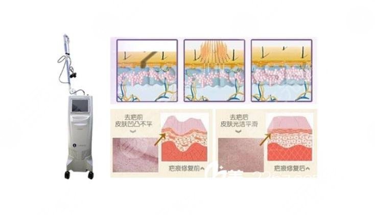 有傷疤怎么去掉？