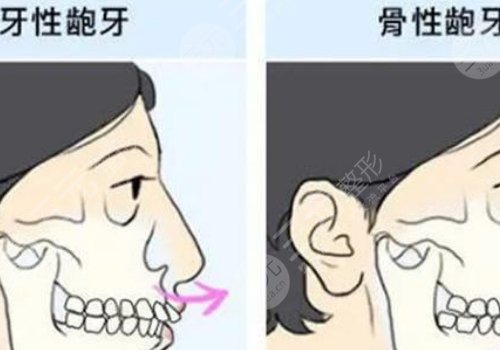 嘴凸怎么辦？