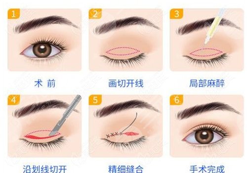 切雙眼皮多久能恢復(fù)自然？