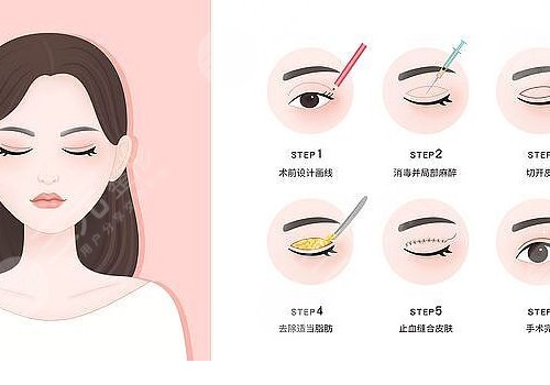 切雙眼皮多久能恢復(fù)自然？