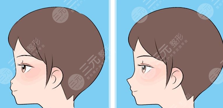 強(qiáng)生瑆珀假體需要注意什么?