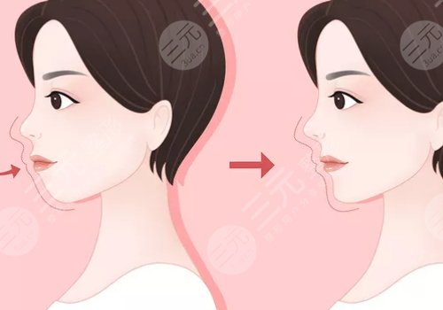 嘴凸是怎么造成的？