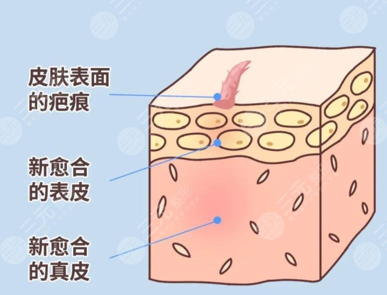 像素激光去疤術后注意事項
