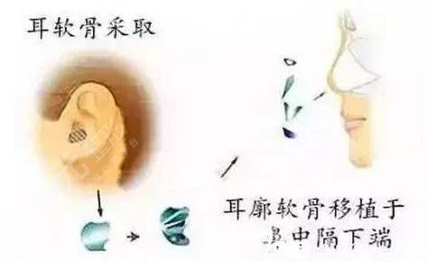 自體軟骨隆鼻有缺點(diǎn)嗎?