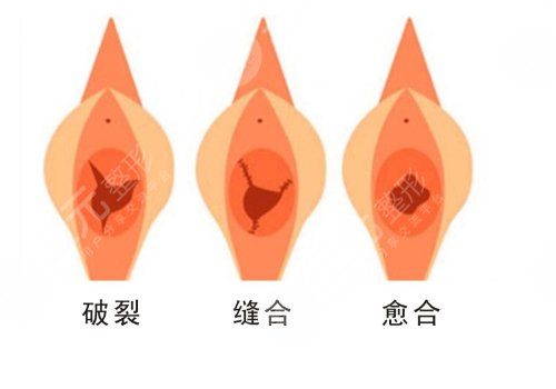 補處膜修復(fù)后會出血嗎？