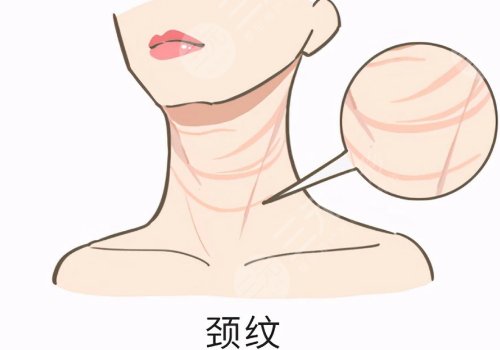 頸紋特別深怎么去除？