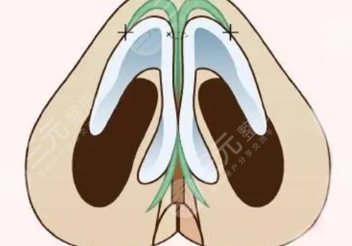 肋骨隆鼻肋骨取了對(duì)身體有影響嗎？