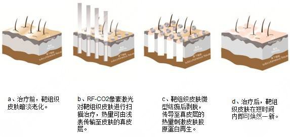像素射頻儀器祛疤有用嗎？