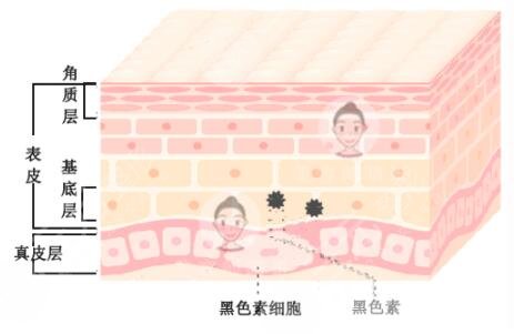 激光祛斑會不會反彈?