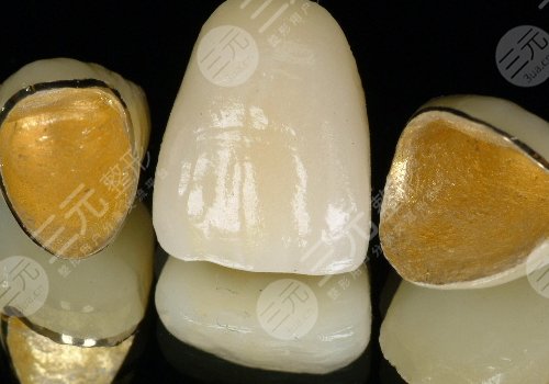鈦合金烤瓷牙多少錢(qián)一顆？