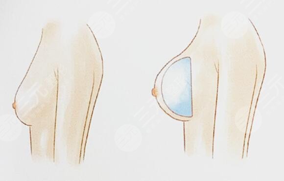 浪漫情懷假體隆胸之后影響哺乳嗎？