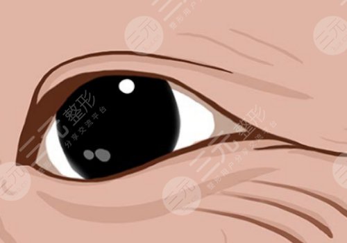 怎么樣去除眼部皺紋？