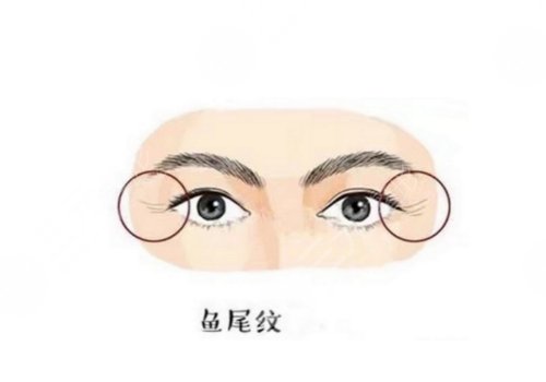 怎么樣去除眼部皺紋？