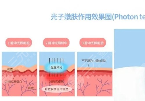 彩光嫩膚和光子嫩膚有什么區(qū)別？