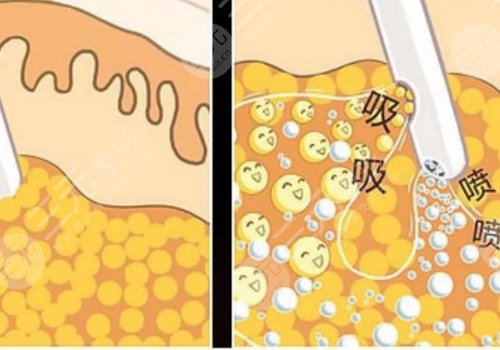 腹部抽脂術(shù)后需要修復(fù)多久？