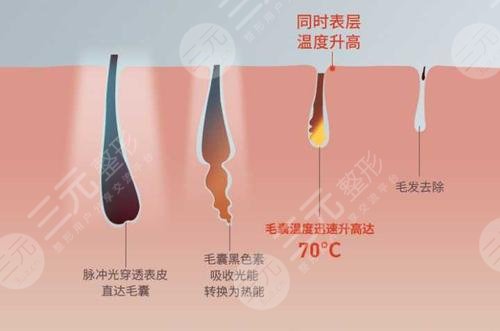 男士激光脫毛效果如何？
