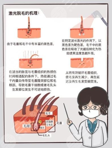 男士激光脫毛效果如何？