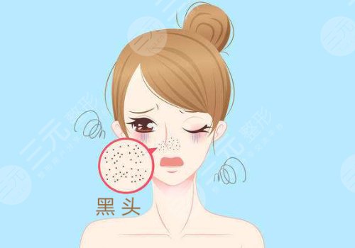 黑頭怎么去除有效？