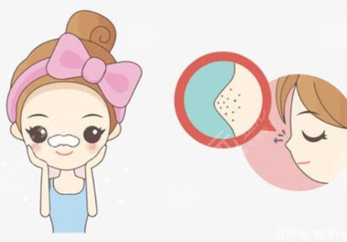 黑頭怎么去除有效？
