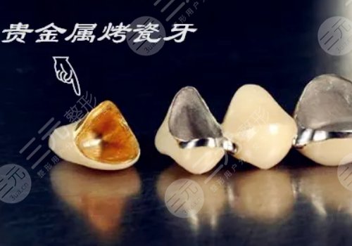 烤瓷牙多少錢(qián)一顆？