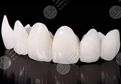 烤瓷牙多少錢(qián)一顆？