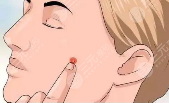 臉上紅色痘印怎么消除？光子嫩膚是好選擇！原理及功效可查！