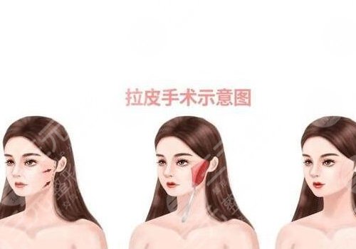 拉皮手術(shù)多大年齡做合適？